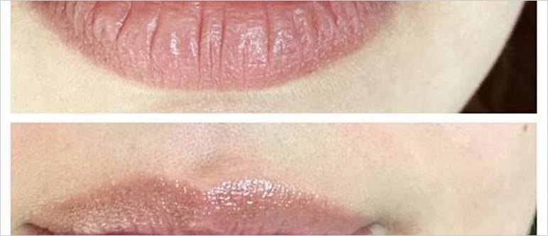 Lip hydration treatment